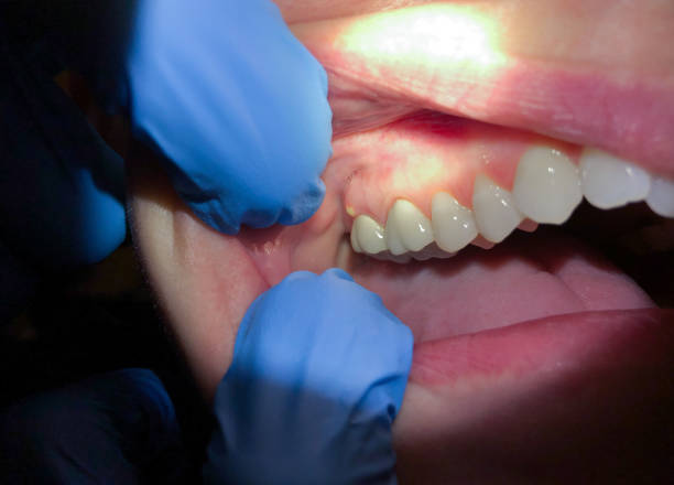 Best Emergency Treatment for Toothache in Cherokee Village, AR