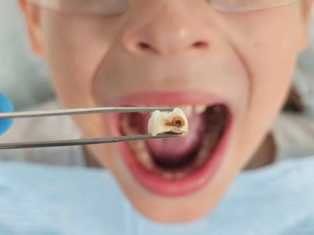 Best Emergency Tooth Extraction in Cherokee Village, AR